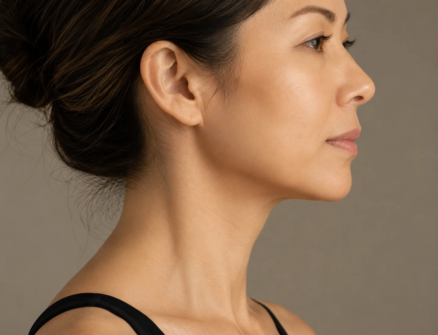 SMAS Facelift Areas Treated